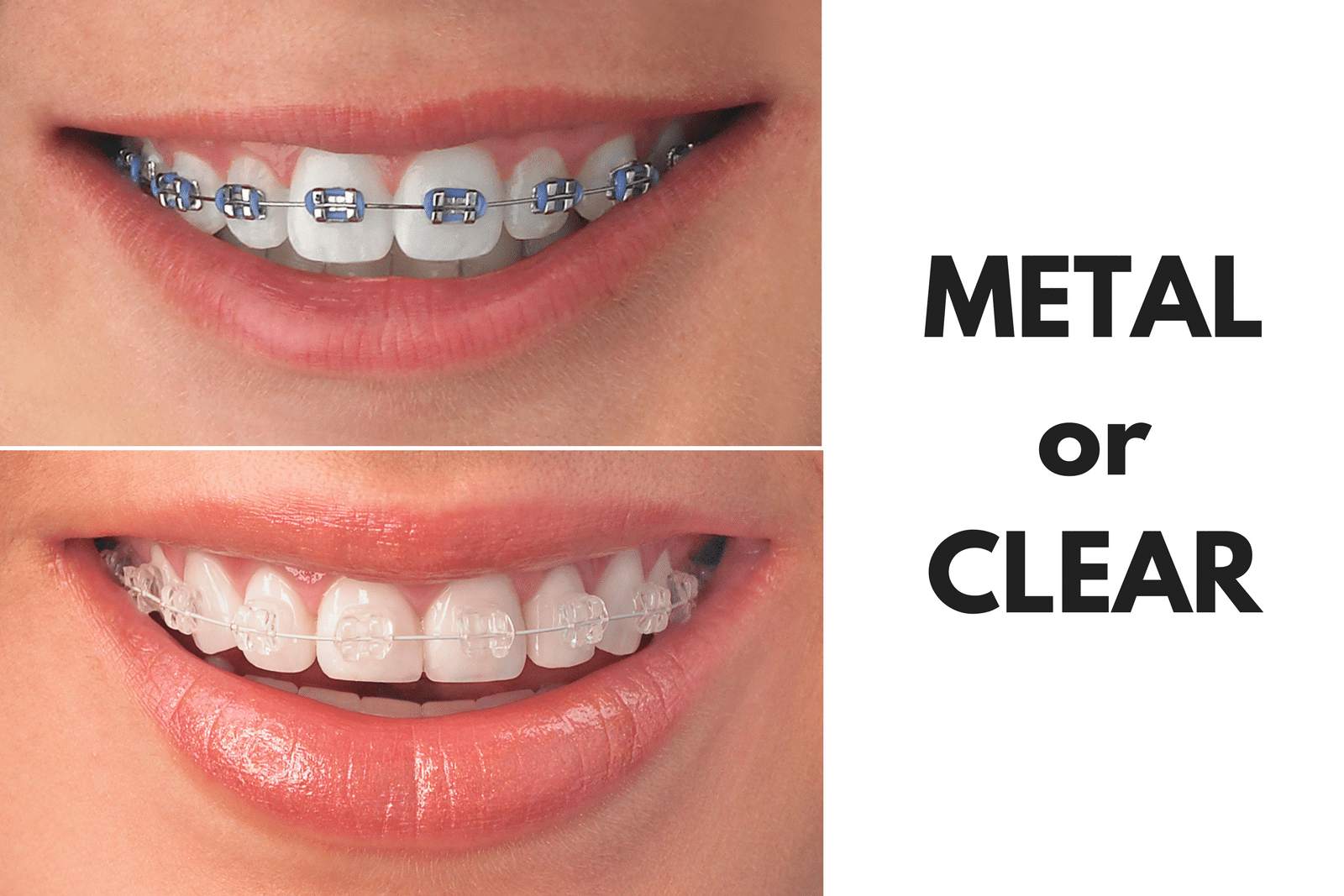 Ask Your Robstown Dentist: Should I Get Metal or Clear Braces?