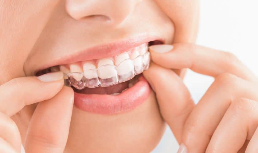 Featured image for “5 Things to Know About Invisalign”