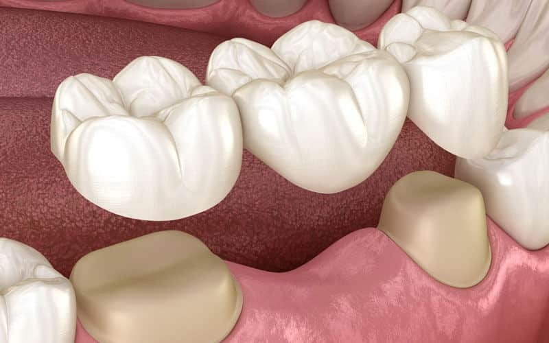 Dental bridge restoration showing replacement teeth connected to adjacent natural teeth.