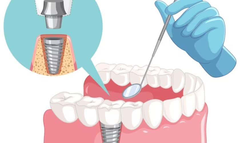 Featured image for “Revitalize Your Smile With Dental Implants: A Comprehensive Guide”