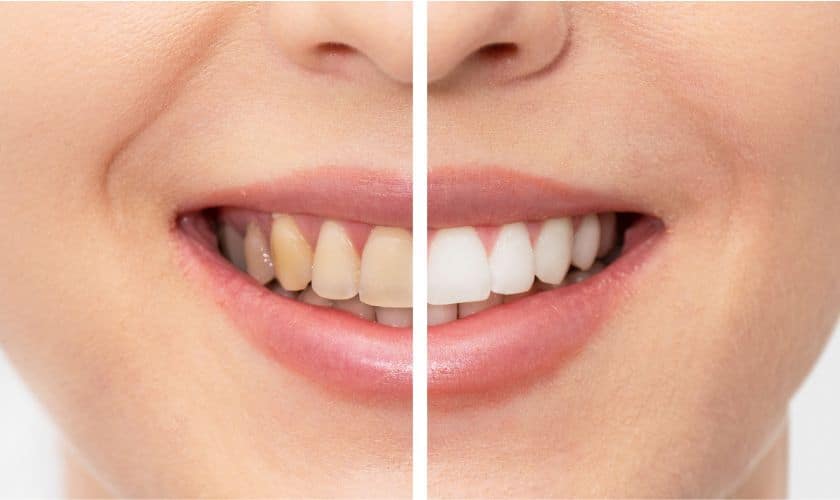 Featured image for “Before and After: Real Stories of Teeth Whitening Success in Robstown”