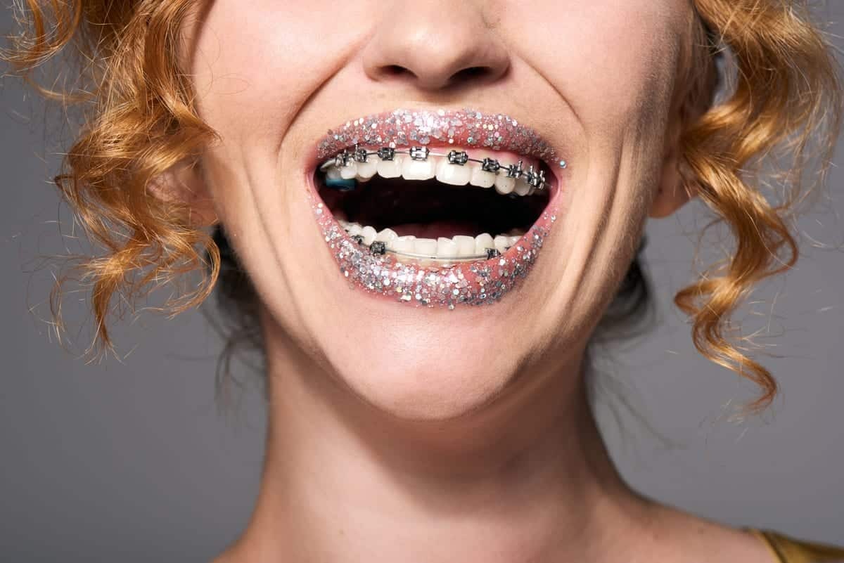 Young woman with metal braces and glittery lips smiling brightly, showing orthodontic treatment results.
